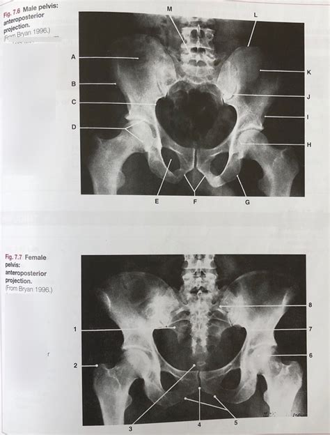 Diagram Of Ap Pelvis X Ray Quizlet