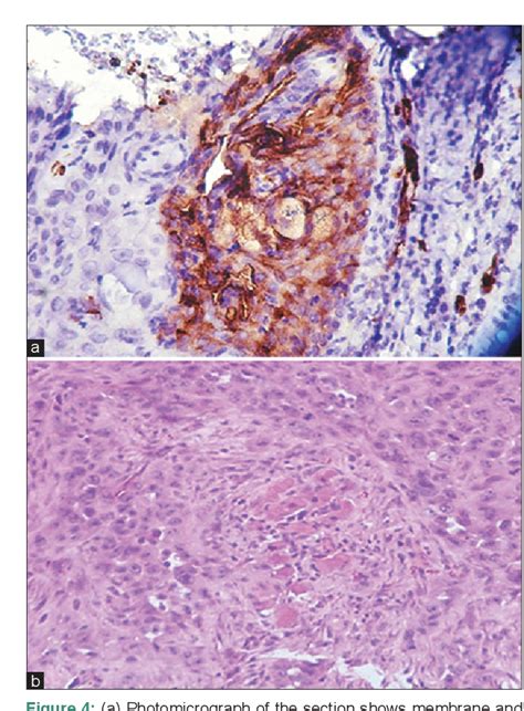 PDF Expression Of Mucin 4 In Leukoplakia And Oral Squamous Cell