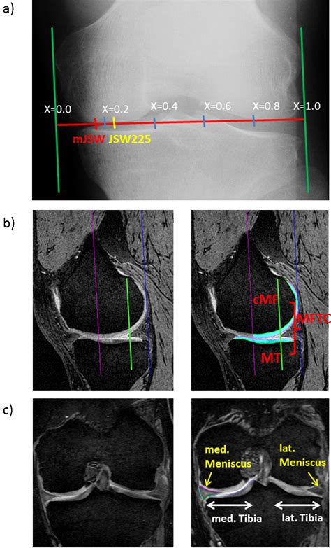 Contribution Of Regional 3d Meniscus And Cartilage Morphometry By Mri