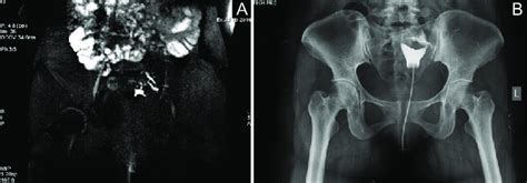 years  nullipara   hsg subtracted images