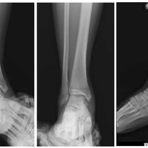 The Varus And Valgus Stress Views And Anterior Drawer View In X Ray 4 Download Scientific