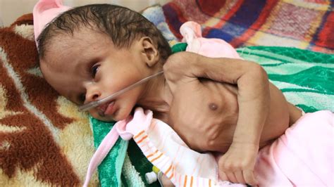 Famine is already killing children in Yemen