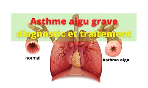 Asthme Aigu Grave Diagnostic Et Traitement Infirmier Pro