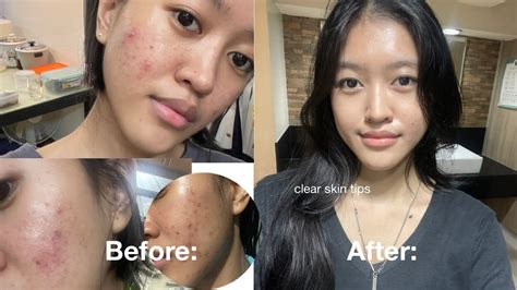 How I Cleared My Skin Without Accutane Youtube