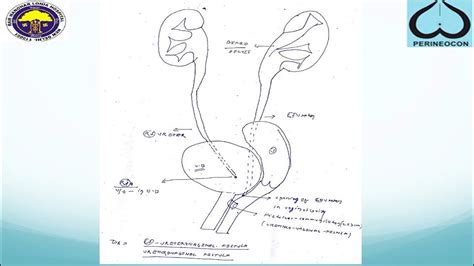 Perineocon Vvf Vesicovaginal Fistula Repair By Dr H S Bhatyal