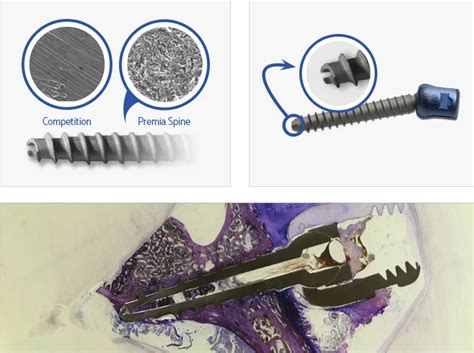 Pedicle Screw