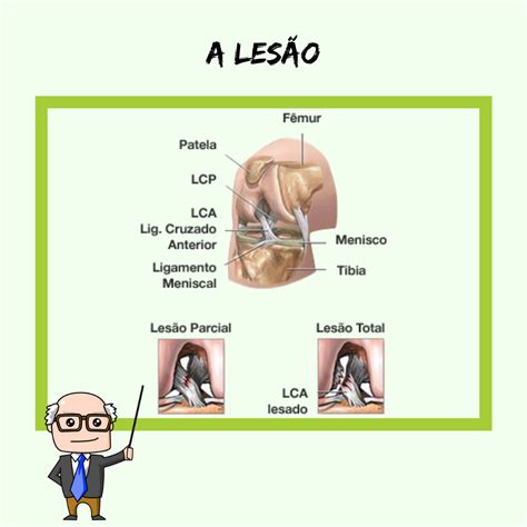 Les O Do Lca Tudo Que Voc Precisa Saber Parte Medicina