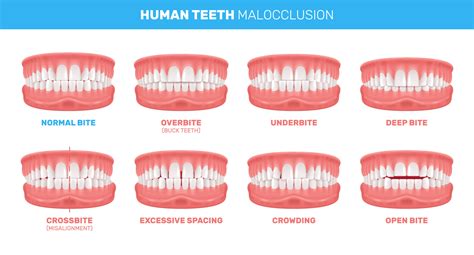 Understanding Malocclusions Types Effects And Treatments