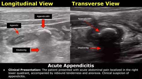 Appendix Ultrasound Reporting Appendicitis Scan Reports How To