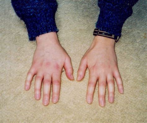 Inflammatory Arthritis In The Hand Before Treatment Rheumexam Atlas