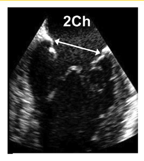 Figure From Challenges Of Percutaneous Balloon Mitral Valvuloplasty