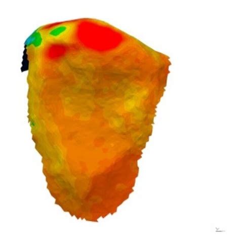 Palatal View Of The Three Dimensional Comparison Of The Re Alignment Of