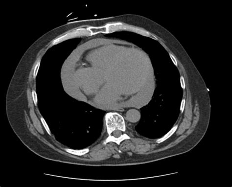 Pericardial Window for Acute Pericarditis After Radiofrequency Ablation - Authorea