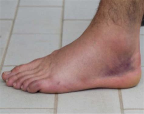 Lesão de Ligamento no Tornozelo