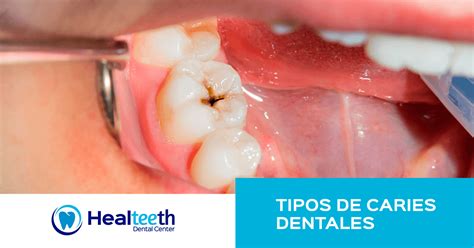 Tipos De Caries Dentales