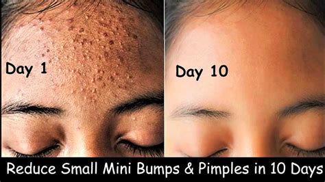 Acne Treatment At Home 3 Day Acne Removal Challenge Acne Treatment