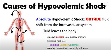 Hypovolemic Shock Wikipedia, 57% OFF