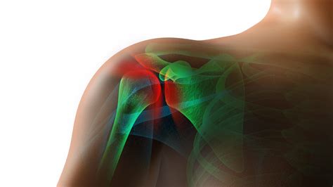 Rotator Cuff Tendonitis