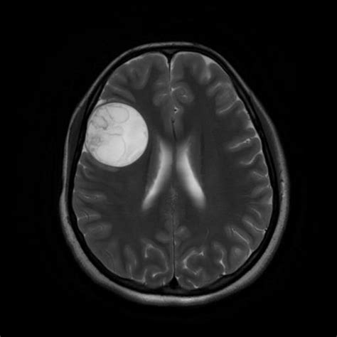 Intracranial Hydatid Cyst Mri And Mr Spectroscopy Imaging Features