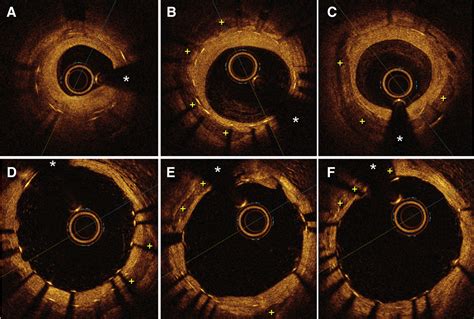 Coronary Lithoplasty For The Treatment Of Undilatable Calcified De Novo