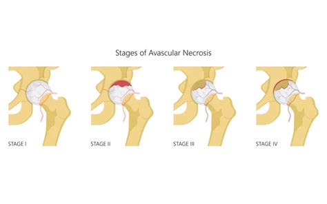 Avascular Necrosis Treatment In Mumbai Dr Divyesh