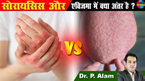 Psoriasis V S Eczema Allergy Itching In Body Ayurveda सोरायसिस