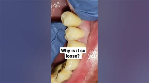 Adult Tooth Falling Out Youtube