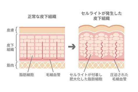 セルライトを消す方法｜ローラーは効果がある？脂肪細胞が増える原因と対策｜infoseekニュース