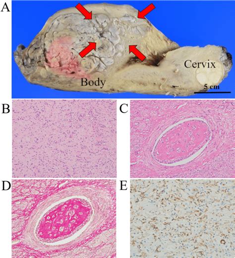 The Macroscopic And Microscopic Findings And Immunohistochemical