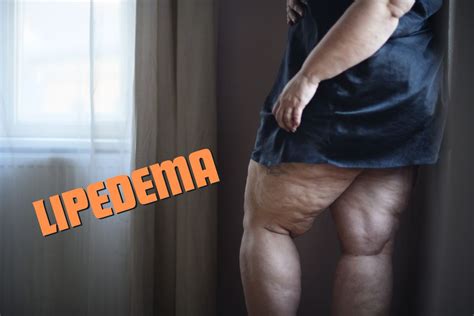 O que é lipedema Tudo que você sempre quis saber SaúdeLab