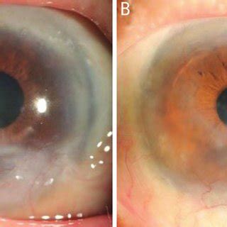 The Slit Lamp Retroillumination Photos Of Peripheral PCO Development At