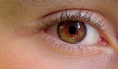 Lidrandentzündung Symptome und Hausmittel bei Blepharitis