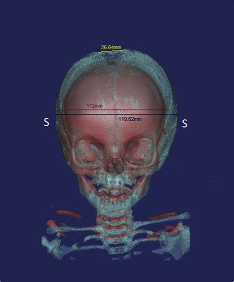 Analysis Of The Cephalometric Changes In The First Months After