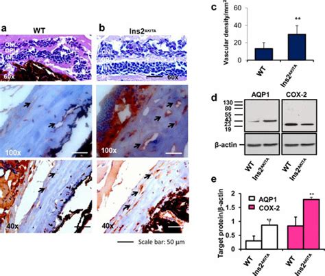 Retinal Neovascularization And Higher Expression Of Aqp And Cox In