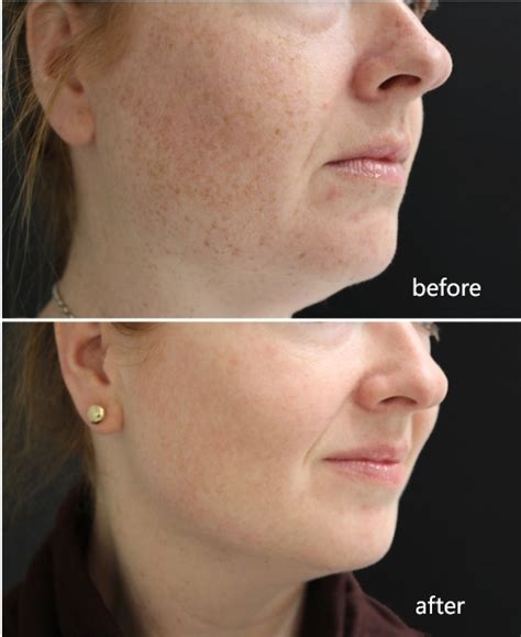Bbl Laser Treatment Machine For Hair Removal And Anti Aging