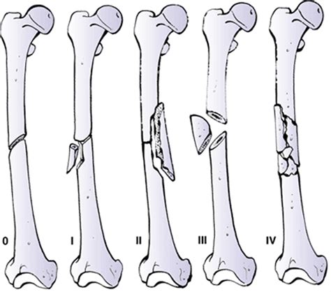 Femoral Shaft Fractures Trauma Orthobullets