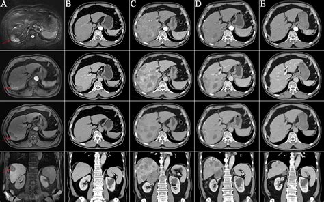Quadrate Lobe Of Liver