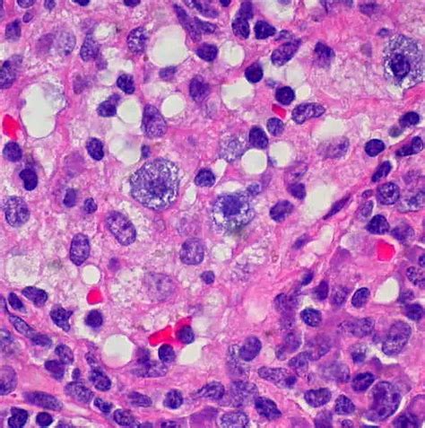 Mast Cells - Definition, Histamine/Inflammation, Vs Basophils