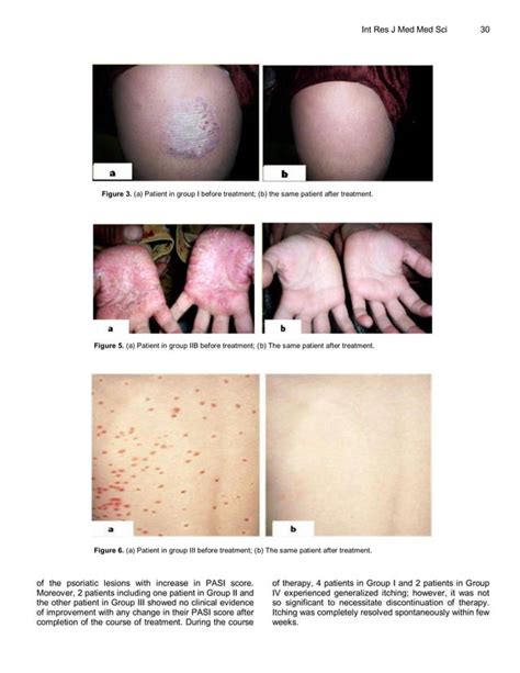 Bee Venom And Propolis Effective In Treating Psoriasis Pdf Free