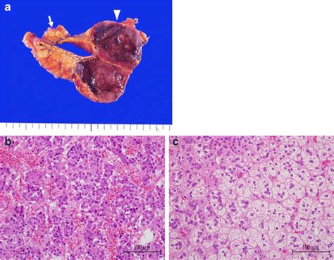 The Cut Section Of The Excised Right Adrenal Gland The Arrow Showing Download Scientific