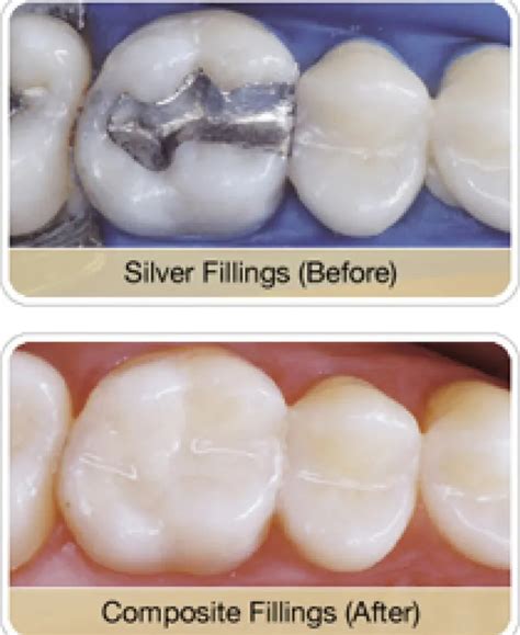 Safe Mercury Amalgam Fillings Removal Dentist Tacoma