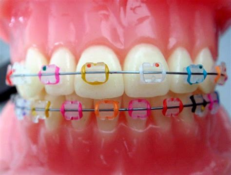 Best Braces Colors To Get For Adults Jeanetta Cady