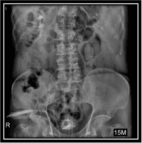 Intravenous Pyelography Ivp Minutes After Instilling The