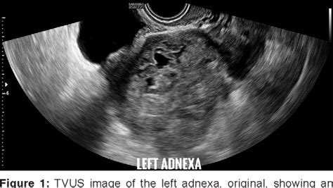 Figure 1 From Mr I” An Eye” For The Preoperative Diagnosis Of Ectopic