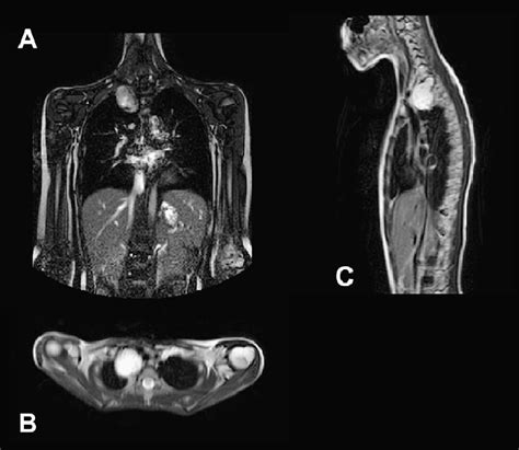 Magnetic Resonance Imaging Of A Voluminous Paraganglioma In The Upper