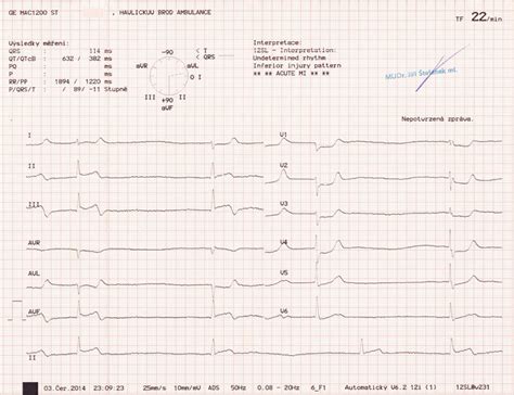 Ekg Z Praxe Medic Na Nemoci Studium Na Lf Uk