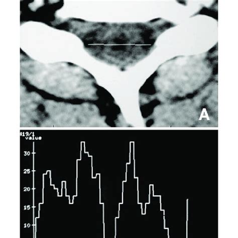 A Computed Tomography Ct Scan Revealing A Low Density Area In The