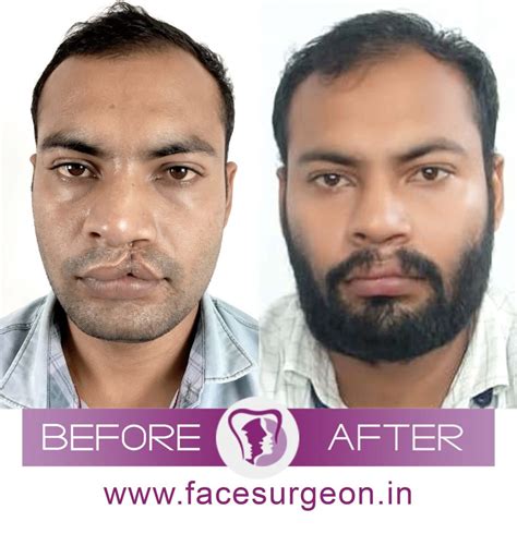 3 Things You Must Know About Cleft Lip Revision Surgery In India