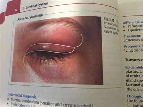 31 Disorders Of The Lacrimal Gland And Drainage System Flashcards