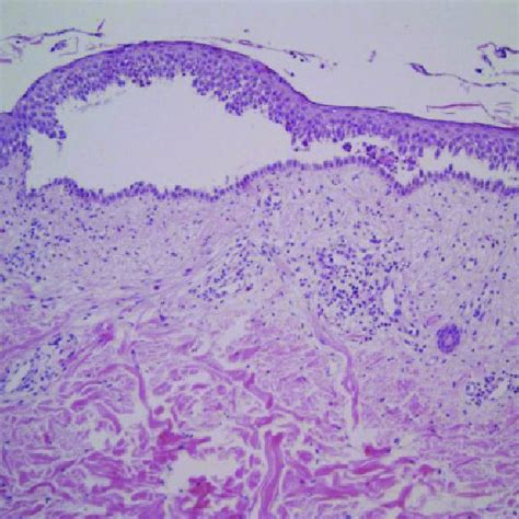 Multiple Tense Vesicles And Bullae On The Erythematous Base In The Abdomen Download